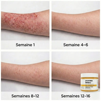 Solution douce et efficace pour apaiser l'eczéma