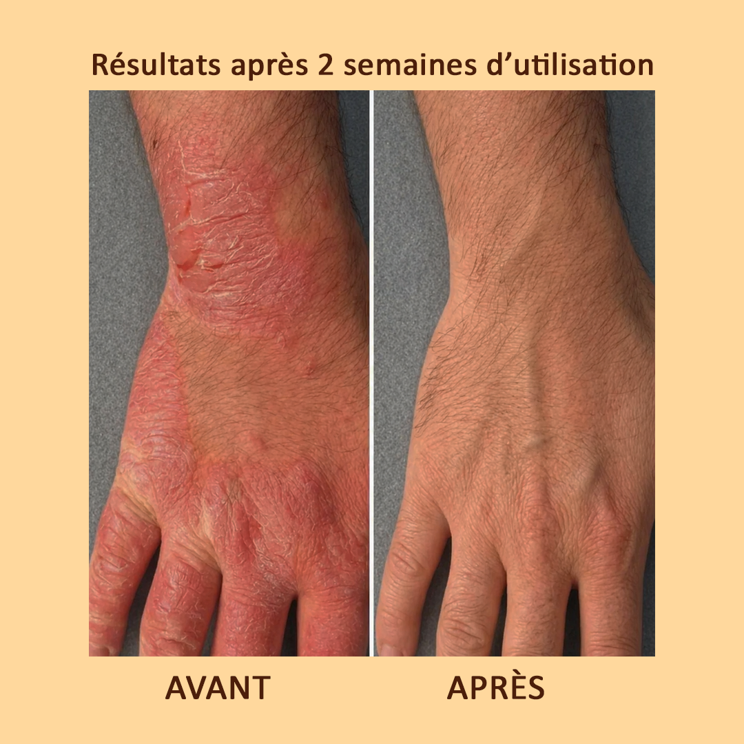 Solution douce et efficace pour apaiser l'eczéma