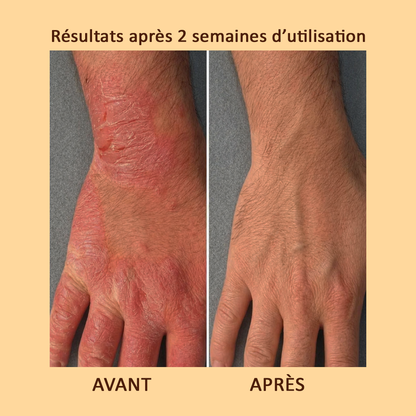 Solution douce et efficace pour apaiser l'eczéma